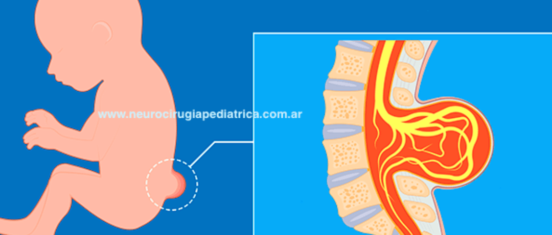 Quistes aracnoideos