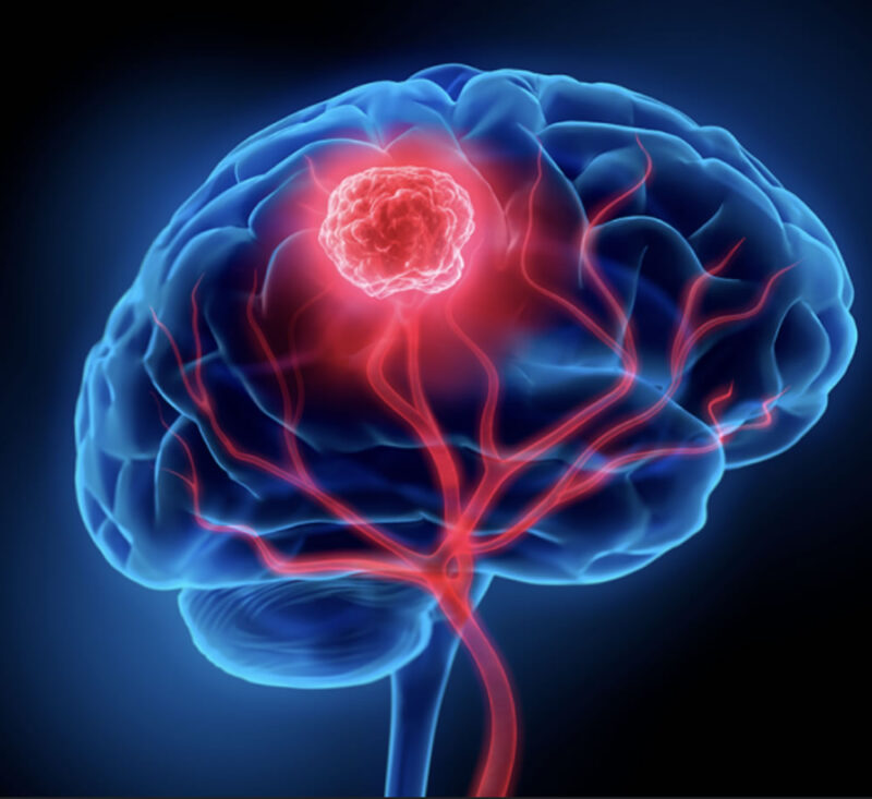 tumores cerebrales