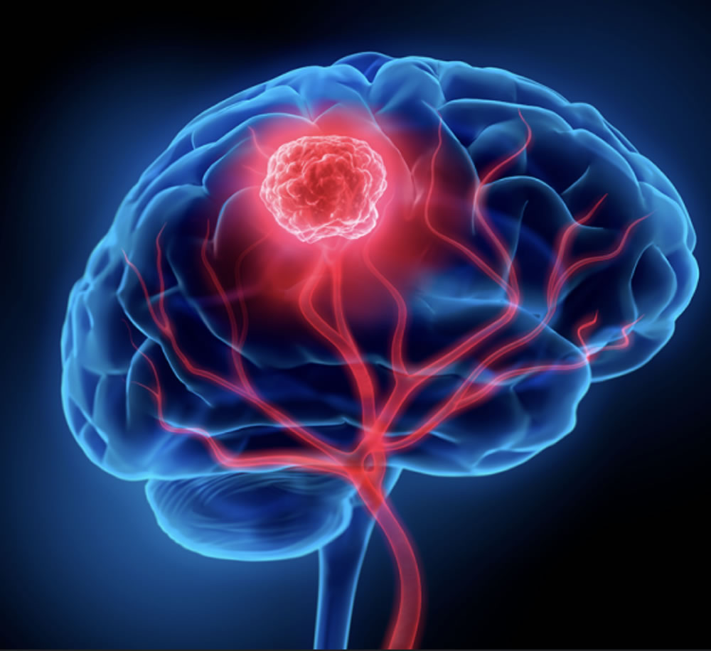 tumores cerebrales