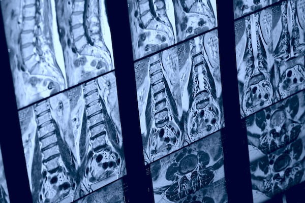 Defectos del cierre del tubo neural
