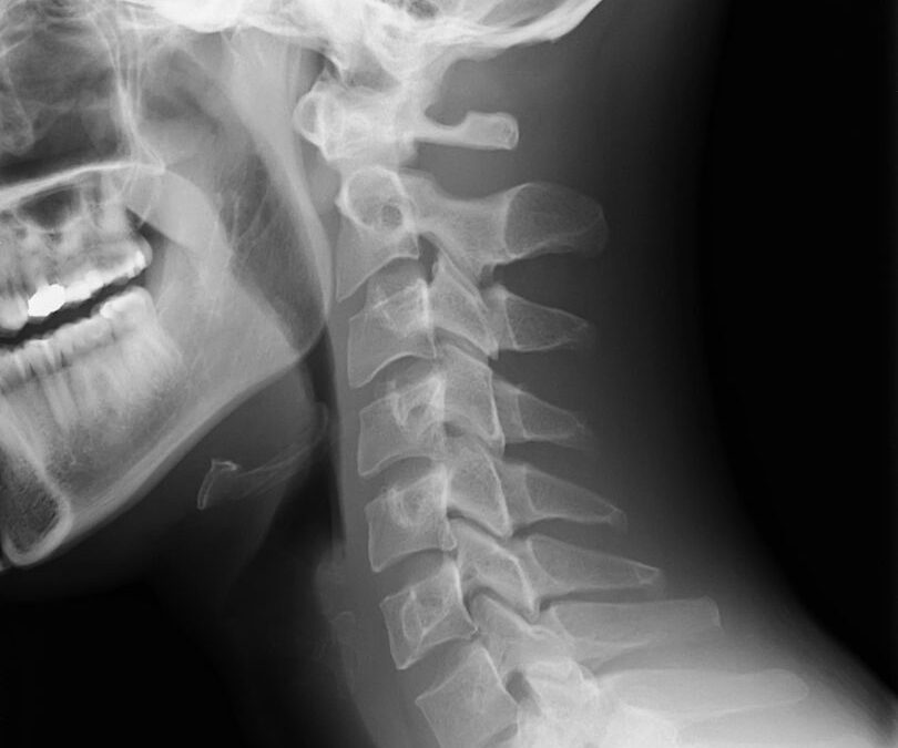 Malformaciones congénitas del cerebro y columna
