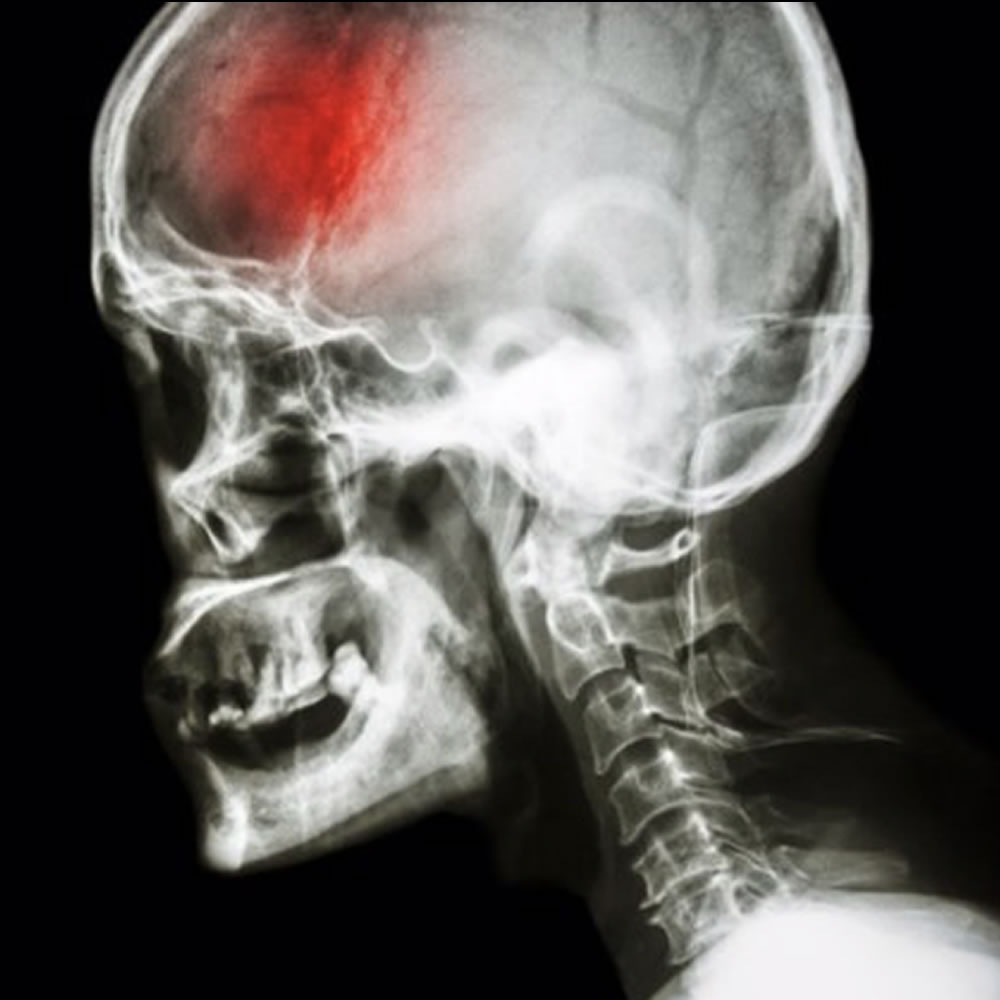 trauma craneal